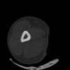 SPORK, NICO - 22.03.1976 - 02.08.2022 - CT obere Extremität - 17:51:17